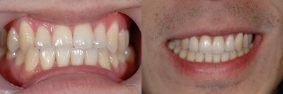 Invisalign before and after photo
