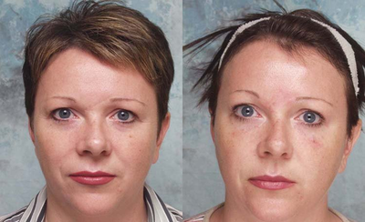 Restylane before and after photo