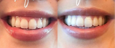 Botox for Gummy Smile before and after photo