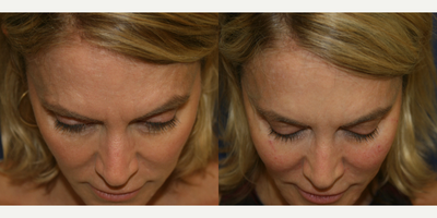 Dermal Fillers before and after photo
