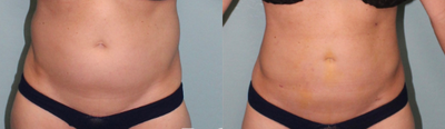Laser Liposuction before and after photo