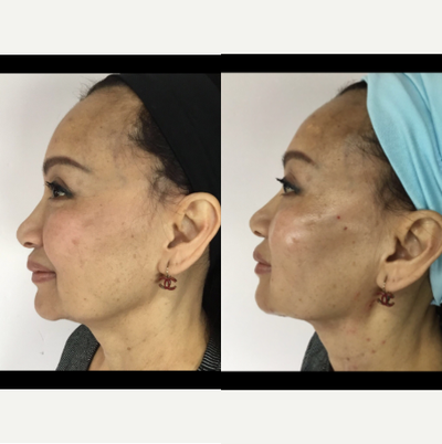 Nonsurgical Facelift before and after photo