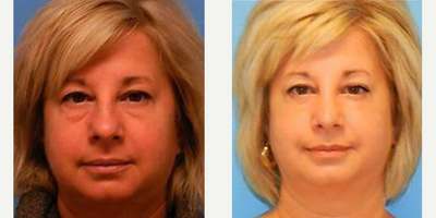 Rhinoplasty before and after photo