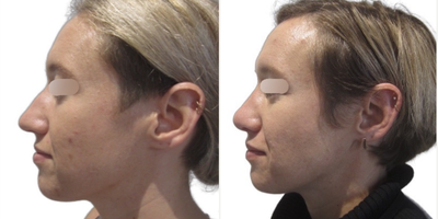 Septoplasty before and after photo