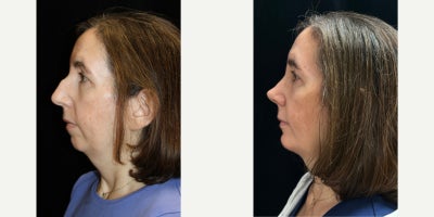 Septoplasty before and after photo