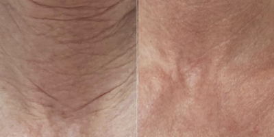 Bellafill before and after photo