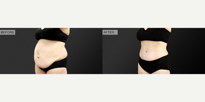 Diastasis Recti Repair before and after photo
