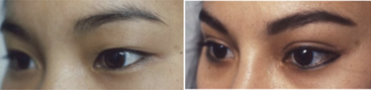Double Eyelid Surgery before and after photo