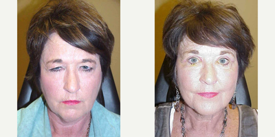 Eyelid Surgery before and after photo