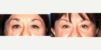 Eyelid Surgery before and after photo