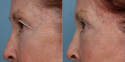 Eyelid Surgery before and after photo