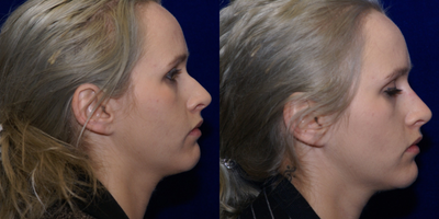 Nonsurgical Nose Job before and after photo