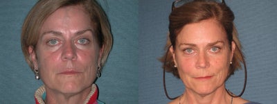 Radiesse before and after photo