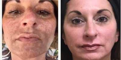 Chemical Peel before and after photo