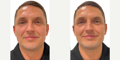 Chin Filler before and after photo