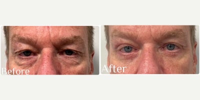 Eyelid Surgery before and after photo