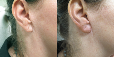 Juvederm before and after photo