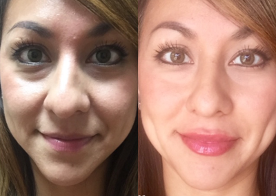 Juvederm before and after photo