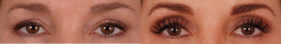 Latisse before and after photo