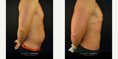 Liposuction before and after photo