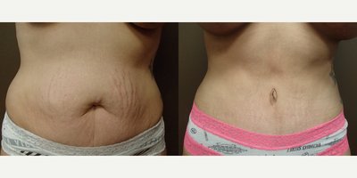 Liposuction before and after photo