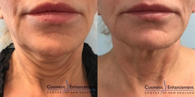 Profound RF before and after photo