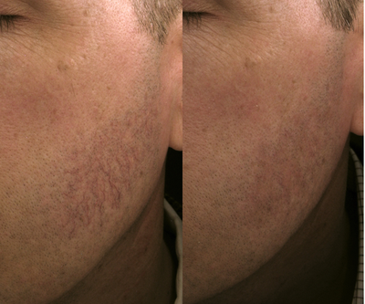 Vbeam before and after photo
