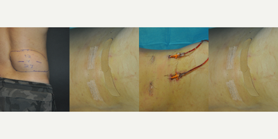 Lipoma Removal before and after photo