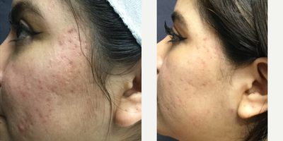 Microneedling before and after photo