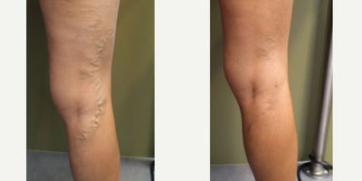 Sclerotherapy before and after photo