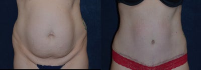 Tummy Tuck before and after photo