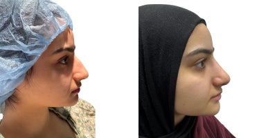 Asian Rhinoplasty before and after photo
