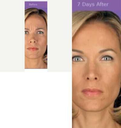 Botox before and after photo