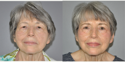 Eyelid Surgery before and after photo