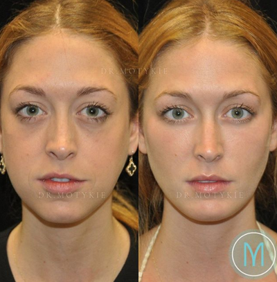 Facial Fat Transfer before and after photo