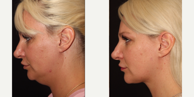 Chin Liposuction before and after photo