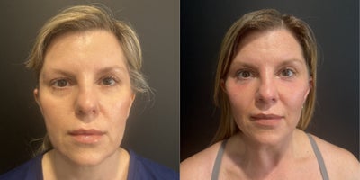 Facial Fat Transfer before and after photo