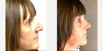 Rhinoplasty before and after photo
