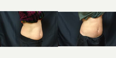 SculpSure before and after photo
