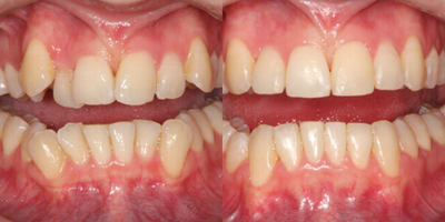 Clear Braces before and after photo