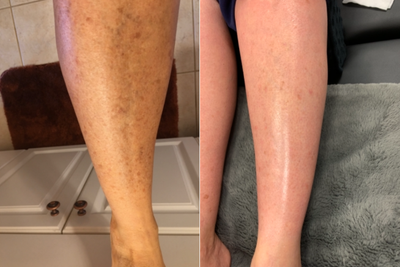 CO2 Laser before and after photo