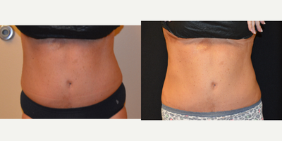 CoolSculpting before and after photo