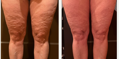 Emsculpt before and after photo
