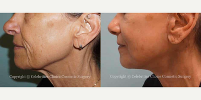 Facelift before and after photo