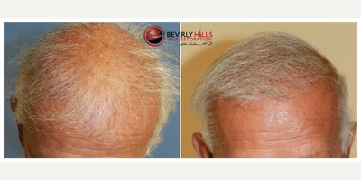 Hair Loss Treatment before and after photo