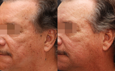Laser Resurfacing before and after photo