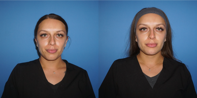 Nonsurgical Nose Job before and after photo