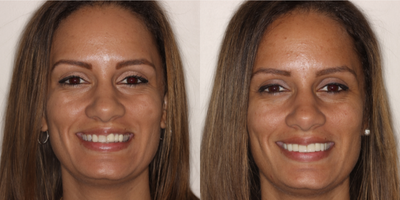 Smile Makeover before and after photo