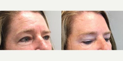 Botox before and after photo