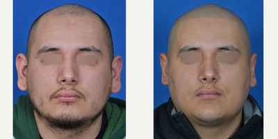 Ear Surgery before and after photo